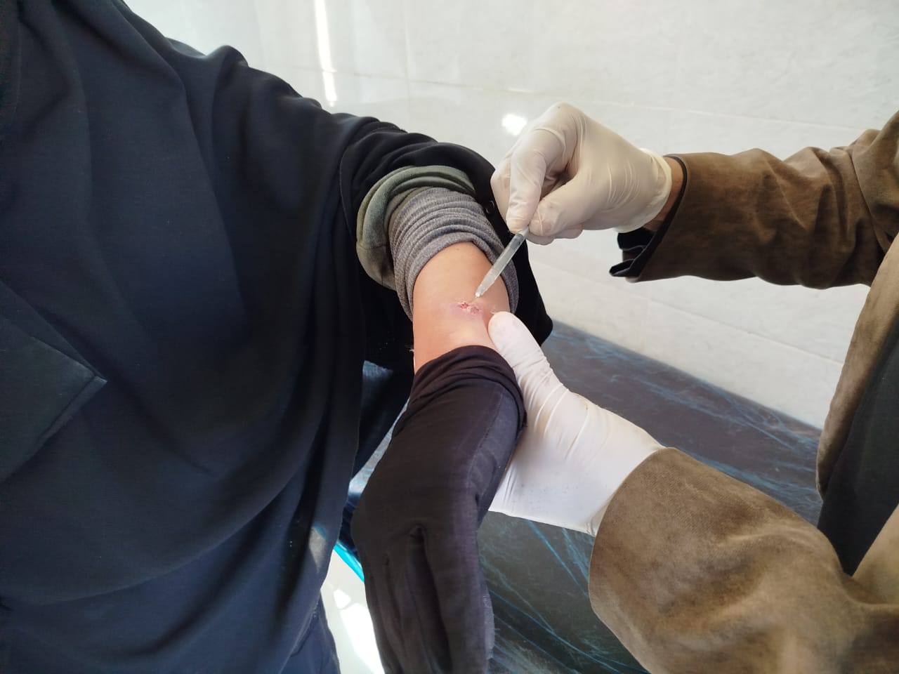 انخفاض إصابات اللشمانيا في منطقة "الهيشة" بنسبة 80 بالمئة